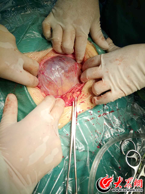菏泽市二院完成两例凶险性中央性前置胎盘产妇的剖宫产术