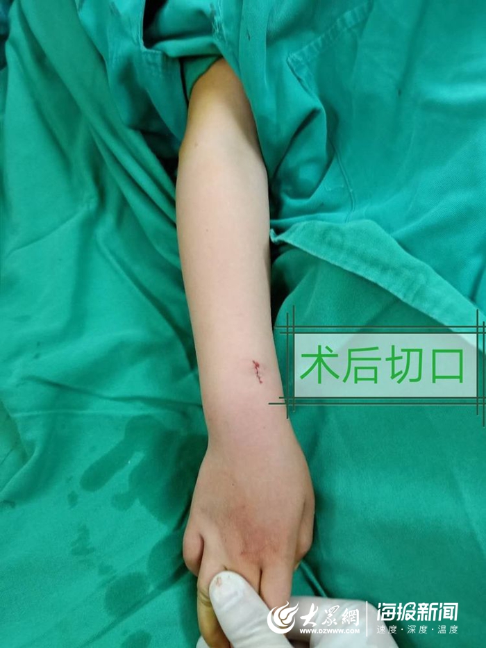菏泽市二院完成首例儿童骨折经皮微创手术治疗