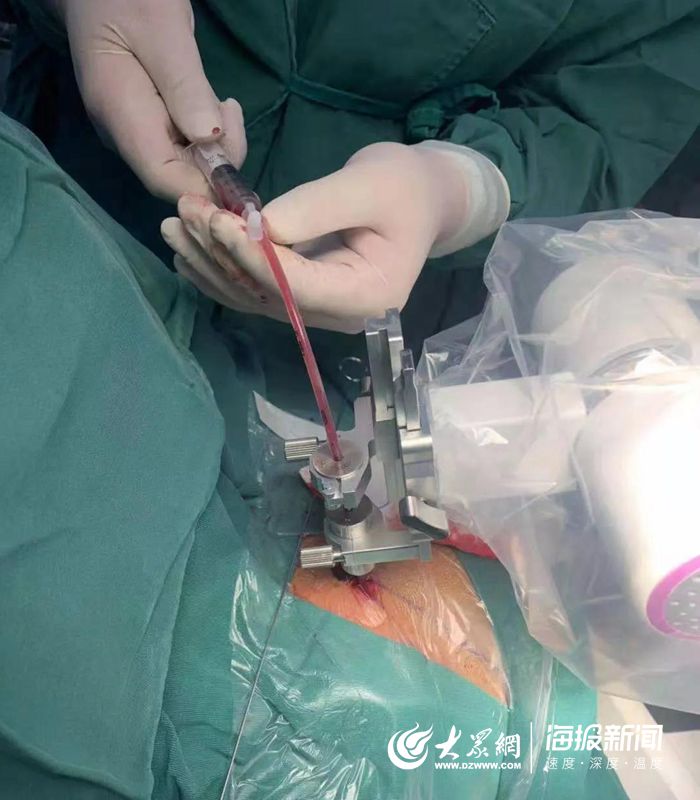 菏泽市立医院为30岁患者行脑干出血精准穿刺引流手术